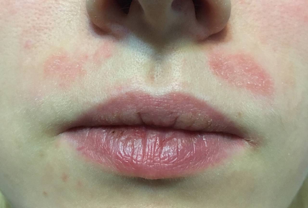Сухость кожи вокруг рта: причины, лечение, как ухаживать, что делать, нужно ли к врачу, почему сушит кожу в области рта