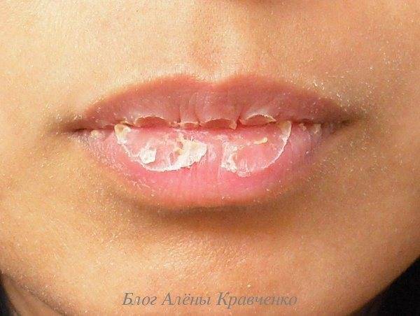 Трескаются уголки губ - какого витамина не хватает. причины трещин у взрослого и ребенка