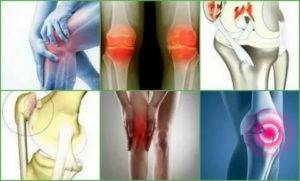 Хондромаляция коленного сустава и медиальных мыщелков бедренной кости 1, 2, 3 и 4 степени