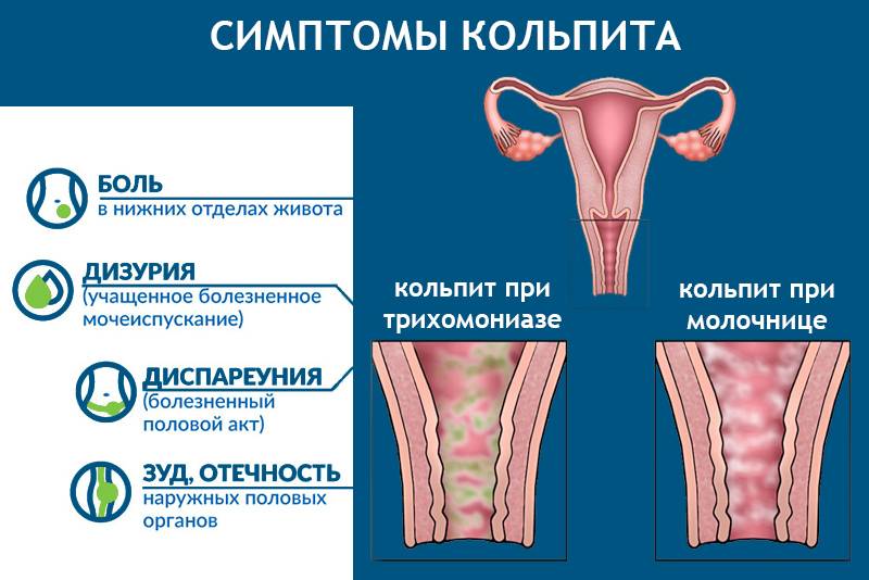 Атрофический вагинит (постменопаузный кольпит) у женщин: симптомы, лечение и прочие особенности