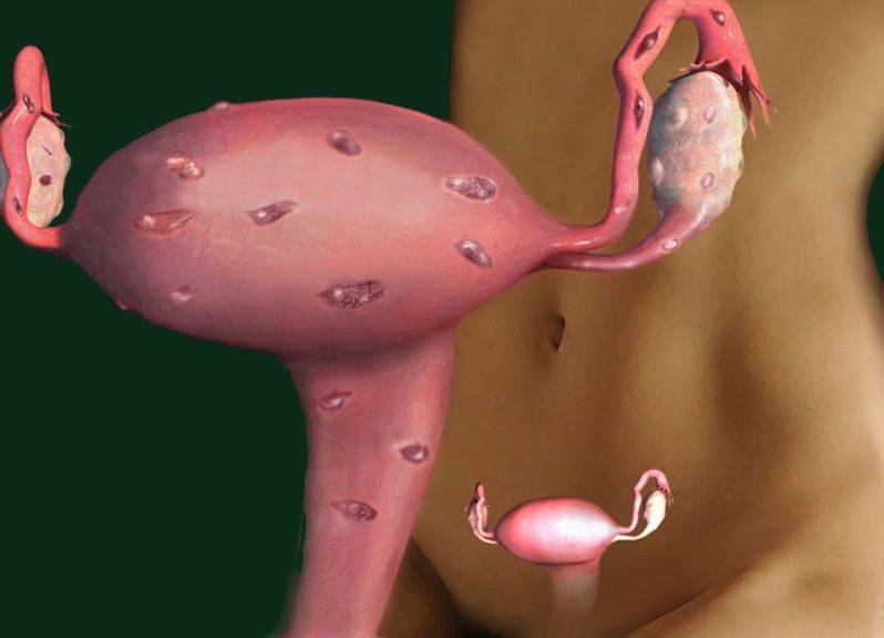 Эндометриоз во время менопаузы