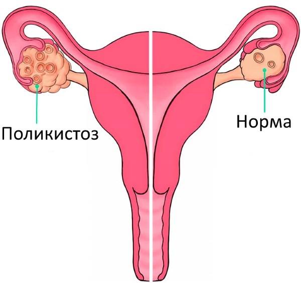 Истощение яичников и беременность: как зачать и выносить ребёнка при патологии