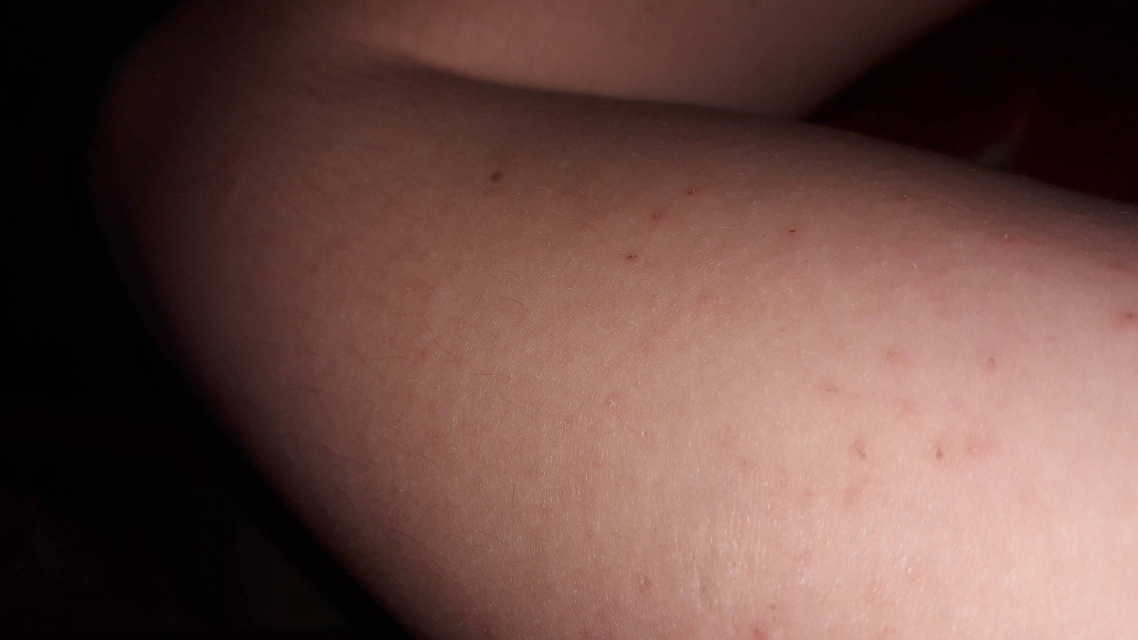 Красная сыпь на теле у взрослого чешется, возможные заболевания