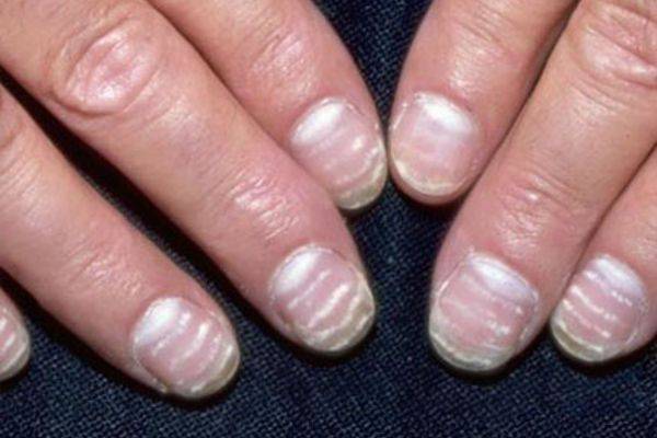 Белые точки на ногтях - что они означают, причины появления у ребенка и взрослого