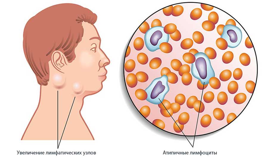 Мононуклеоз у детей картинки