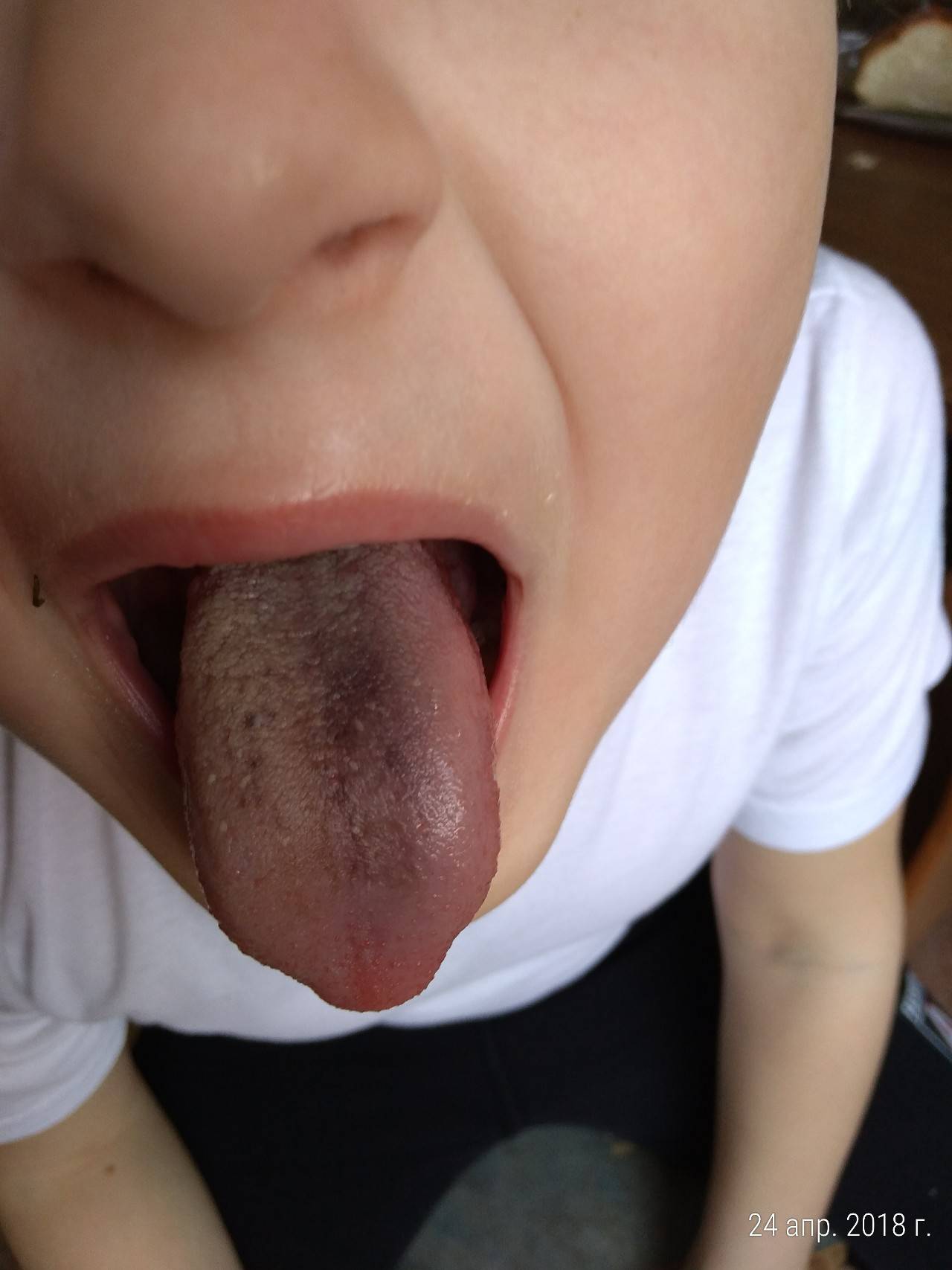 Черный налет на языке у ребенка: причины темного образования, сопутствующие симптомы, диагностика и лечение