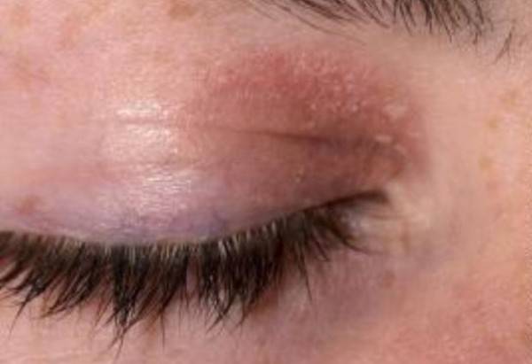 Аллергический отек кожи лица: сухость, зуд и покраснения