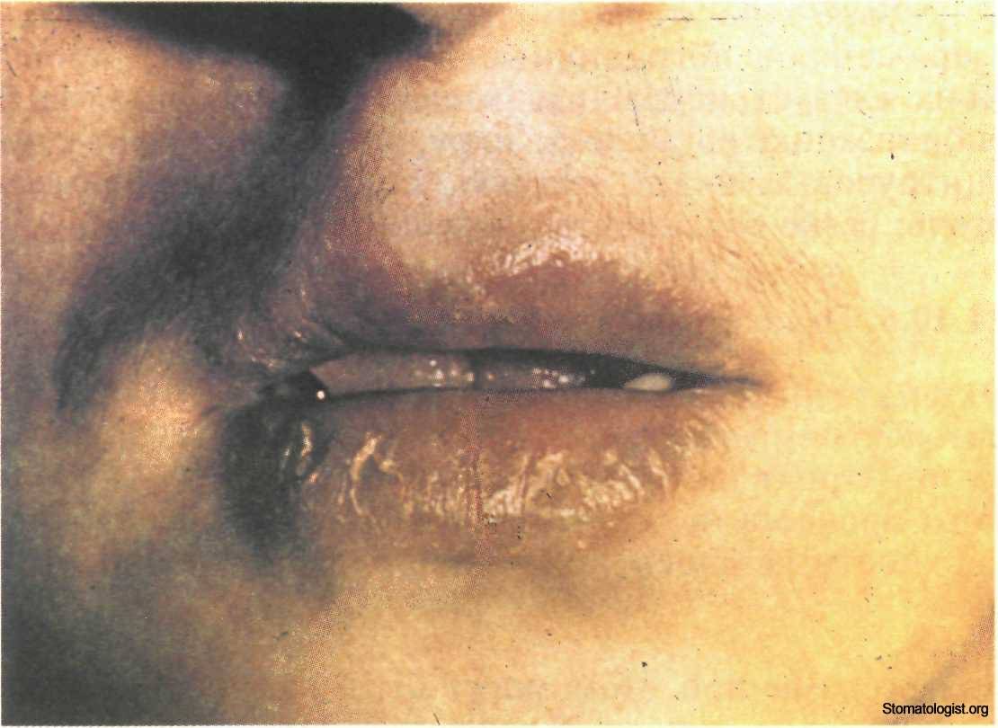 Заеды и трещины в уголках рта у детей: причины и способы лечения губ чем помазать язвочки?