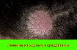 Чем и как вылечить лишай у детей на голове и теле народными средствами?