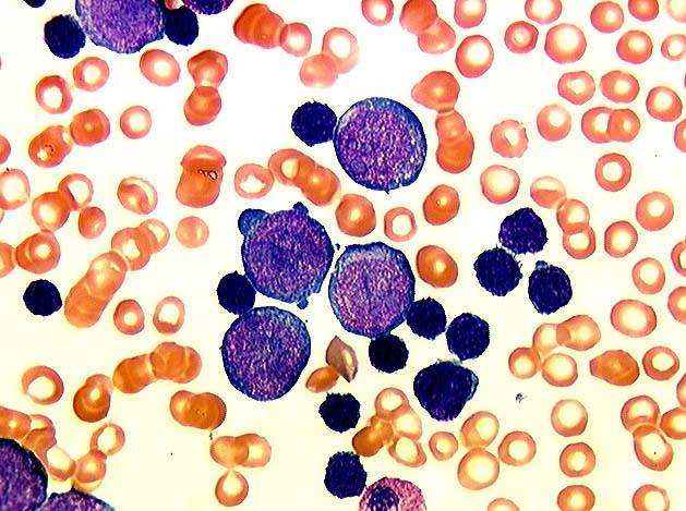 Повышены лимфоциты в крови у ребенка: причины повышенного количества лимфоцитов