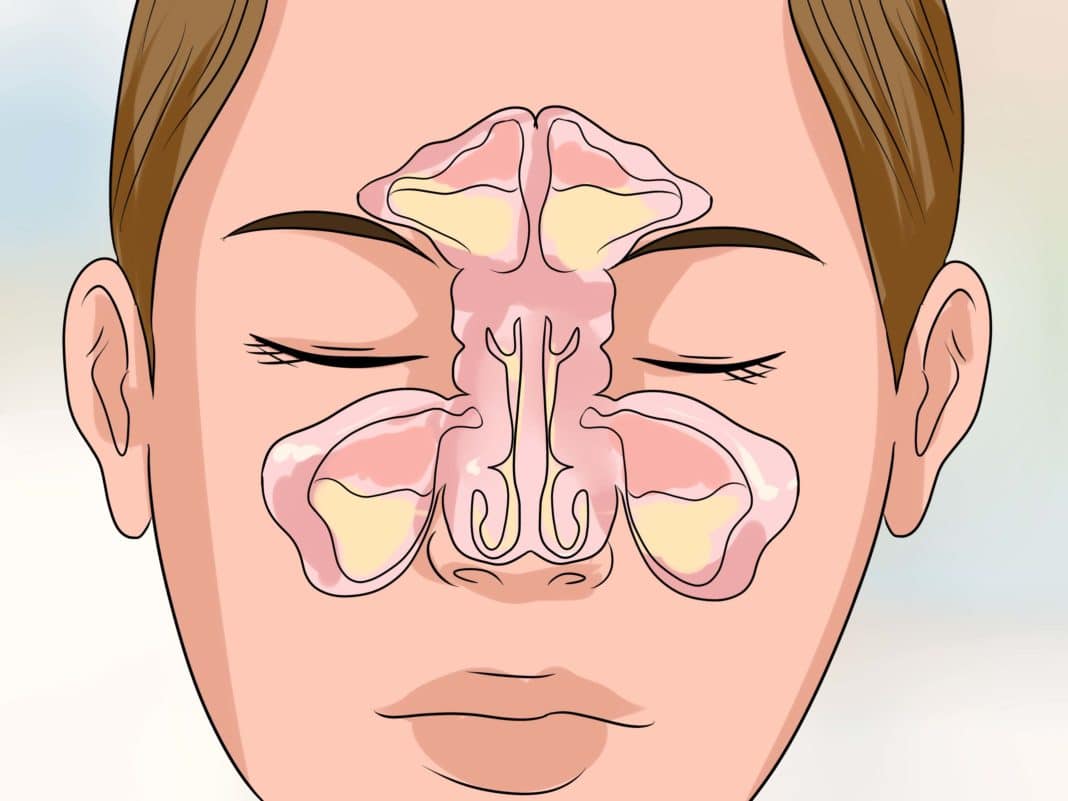 Болячки в носу: чем их лечить у ребенка и взрослого в домашних условиях