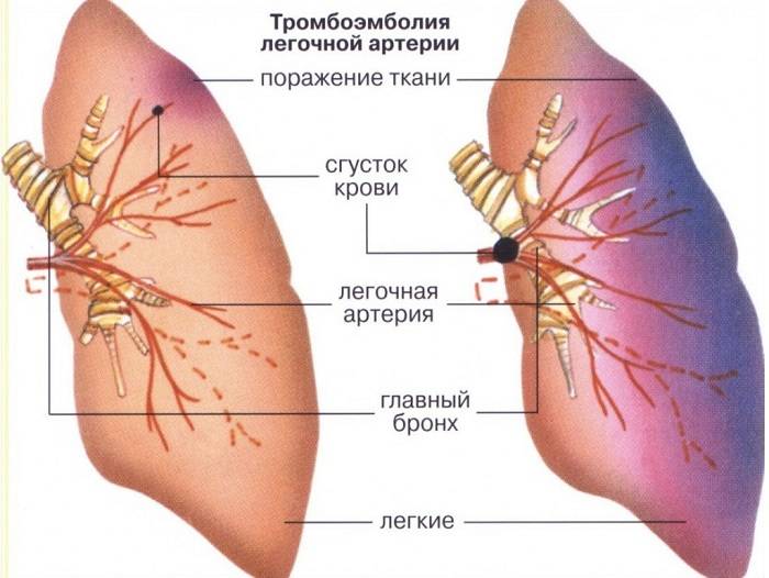 Симптомы, лечение и последствия тромбоэмболии артерии лёгких