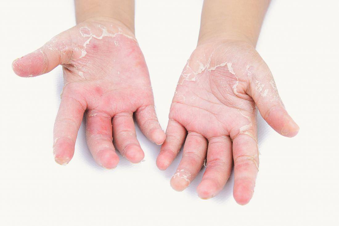 Почему шелушатся подушечки пальцев на руках. как лечить шелушение рук у детей | школа красоты