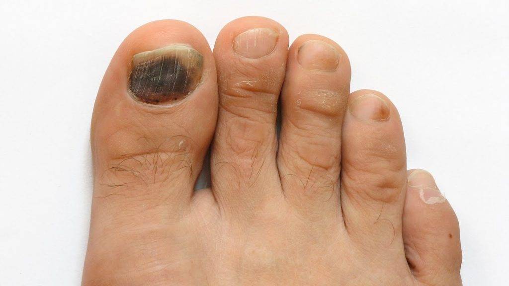 Деформация ногтей на ногах: виды, причины и лечение болезни с фото