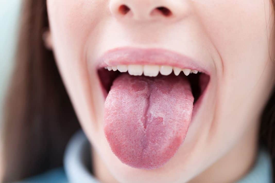 Сухость во рту – симптом всд или следствие лечения?