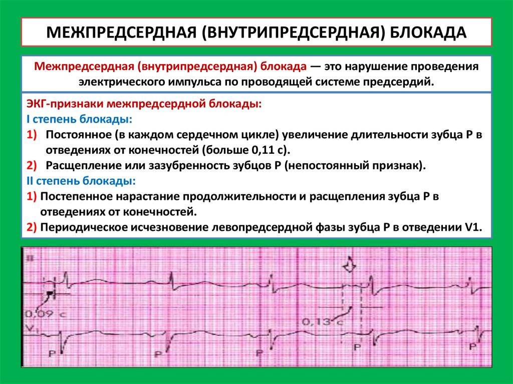 Нарушение внутрижелудочковой проводимости сердца: что это такое, симптомы и лечение