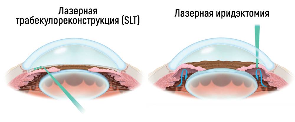 Лазерная иридэктомия: лечение глаукомы, как проводится, послеоперационный период и реабилитация