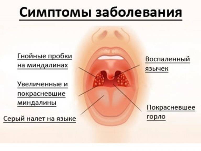 Золотистый стафилококк в носу у взрослых: симптомы и обследование, лечение, лечебные средства и профилактика