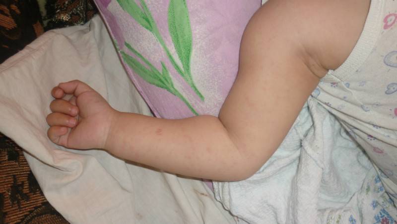 Аллергическая сыпь у детей: как выглядит и почему появляется сыпь у детей разных возрастов. лечение и профилактика аллергии у детей (140 фото)