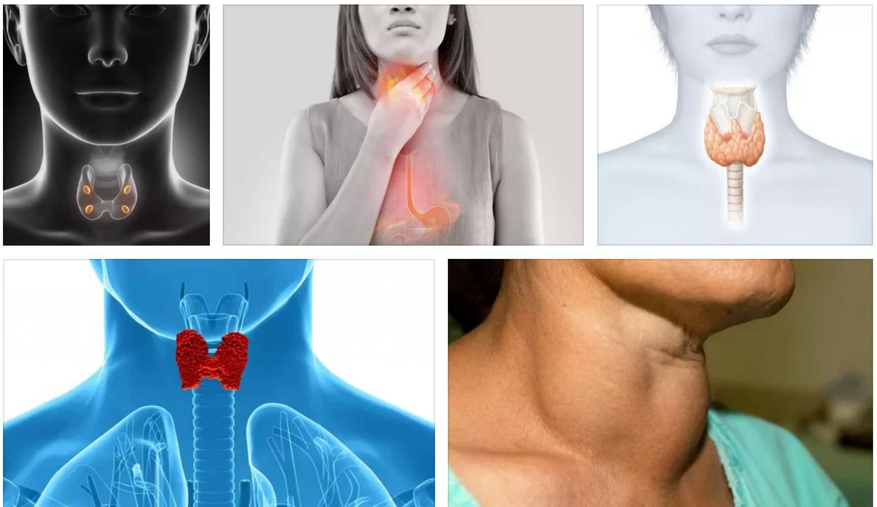 Признаки нарушения щитовидной железы у женщин могут быть схожи с другими заболеваниями