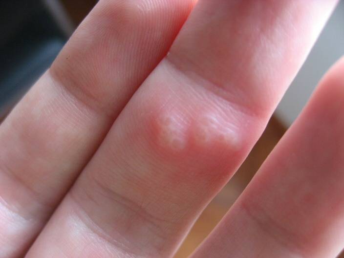 Мелкие пупырышки на руках: почему появились и чешутся, лечение зуда и прыщиков на кистях и пальцах