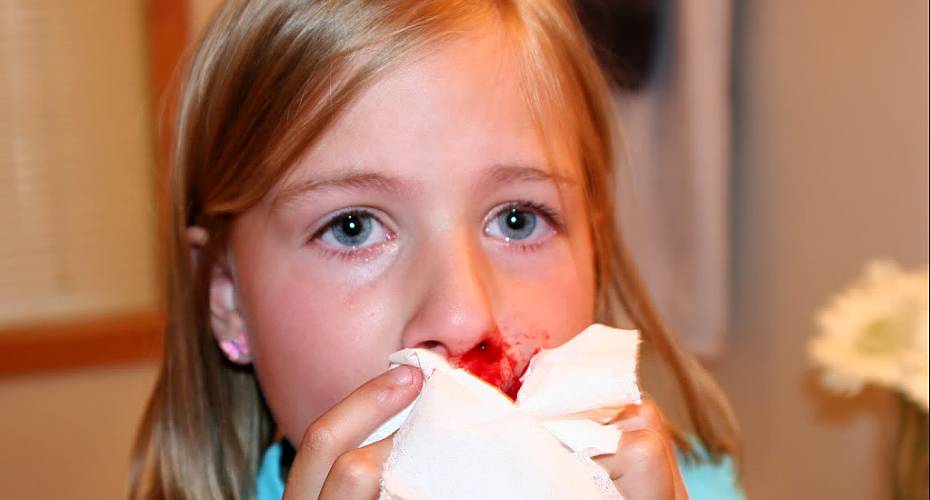 Почему идет кровь из носа у ребенка и как остановить кровотечение из носа. носовое кровотечение у ребенка
