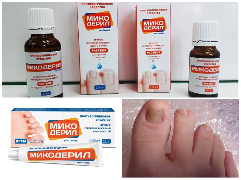 Грибок стопы лечение препараты эффективные отзывы. Микодерил мазь. Капли от грибка Микодерил. Средство от грибка ЕС ногтях. Лекарство от грибка ногтей на ногах.