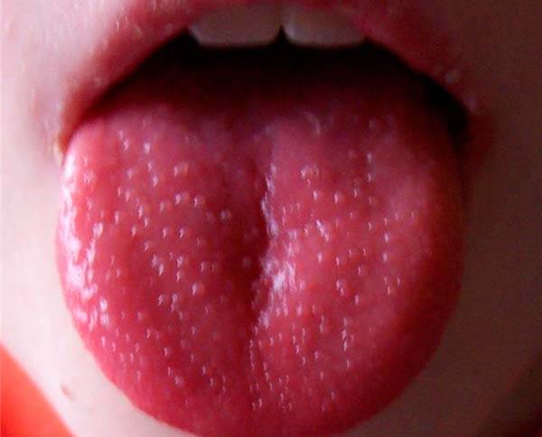 Кровяные и красные волдыри на корне языка ближе к горлу – что это такое, вероятные причины и фото